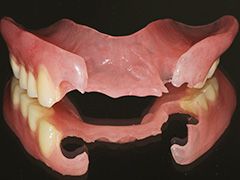 Non-clasp dentures