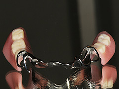 Metal base dentures