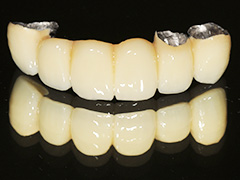 Metal Bond (Porcelain-fused-to-metal crowns)